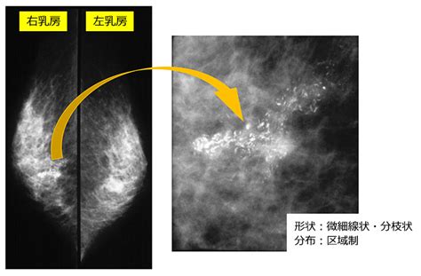 微細石灰化の集簇|乳がん検診のマンモグラフィ検査で石灰化があった場合について。